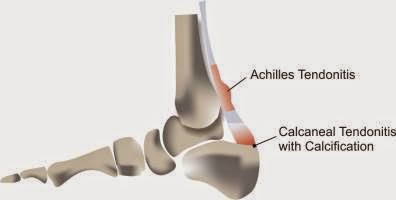 Achilles tendon hot sale calcification treatment